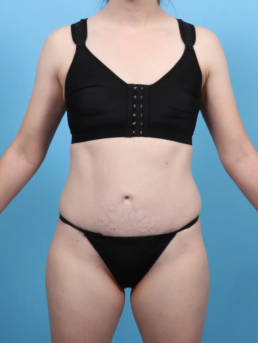 Tummy Tuck Patient Photo - Case 47192 - after view