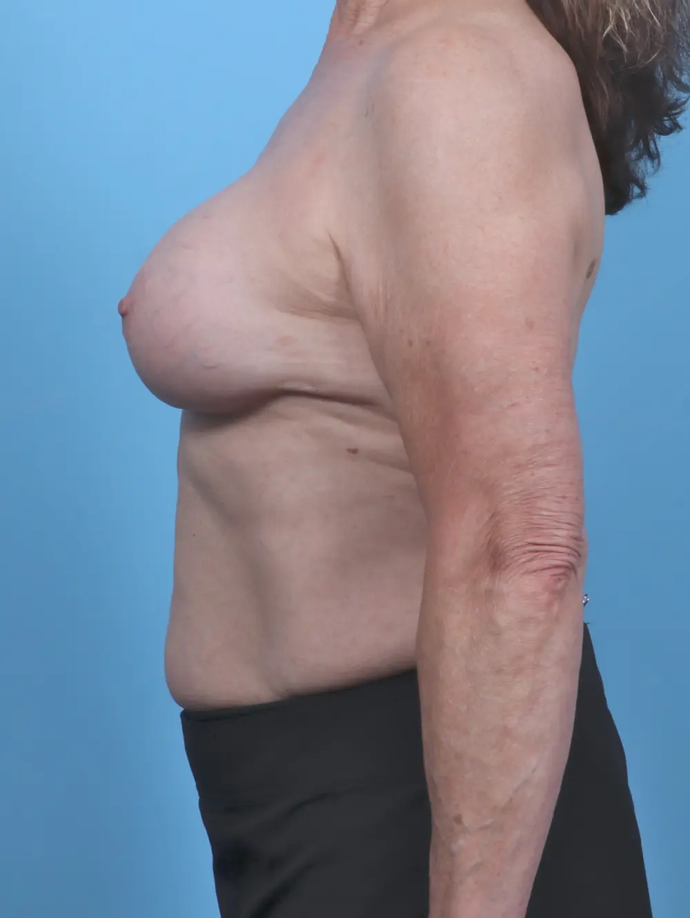 Breast Augmentation Patient Photo - Case 47200 - after view-2