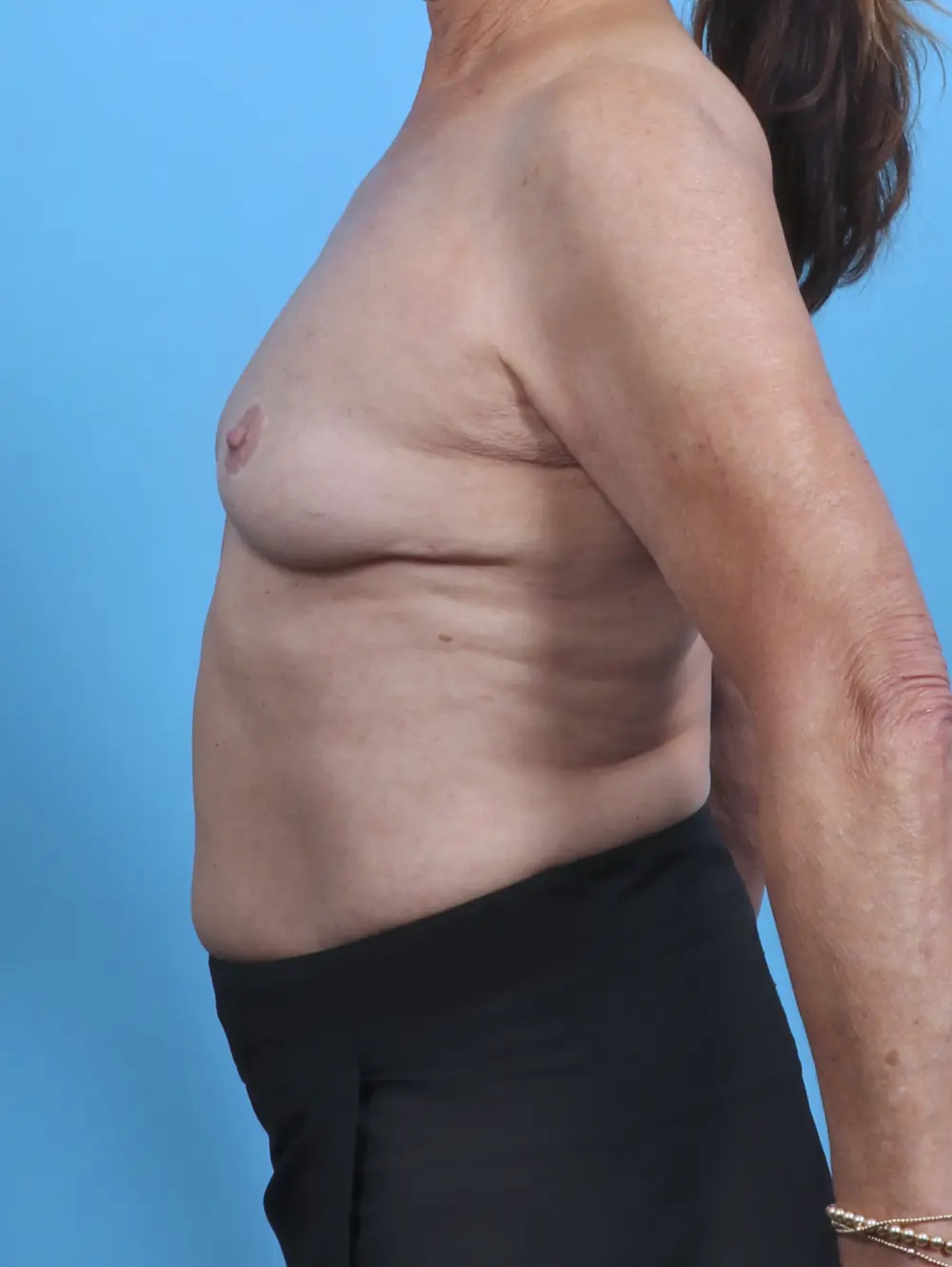 Breast Augmentation Patient Photo - Case 47200 - before view-2