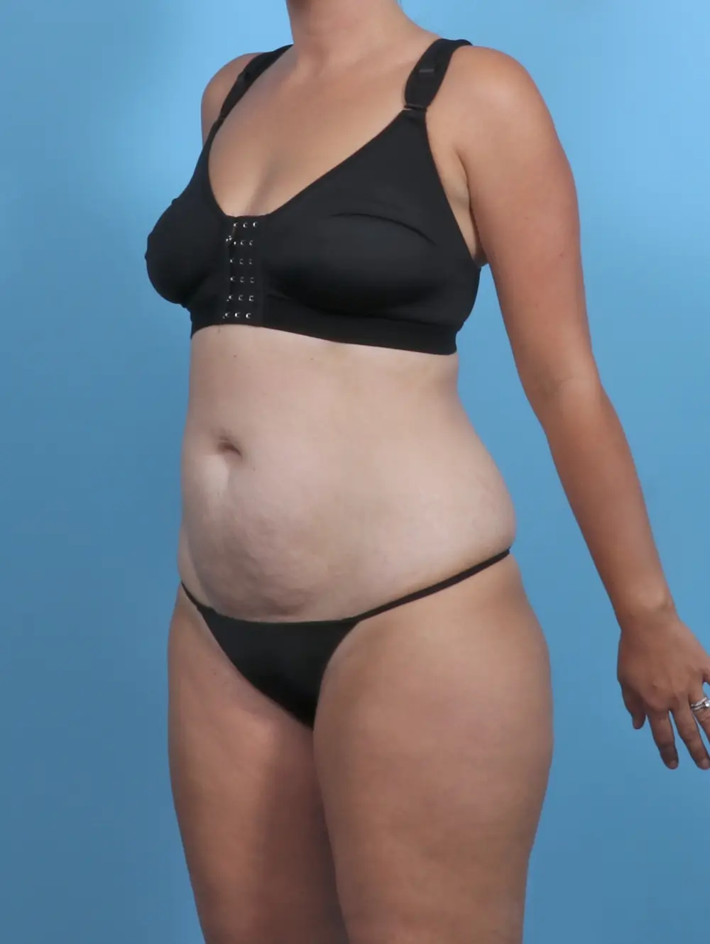 Tummy Tuck Patient Photo - Case 47233 - before view-1
