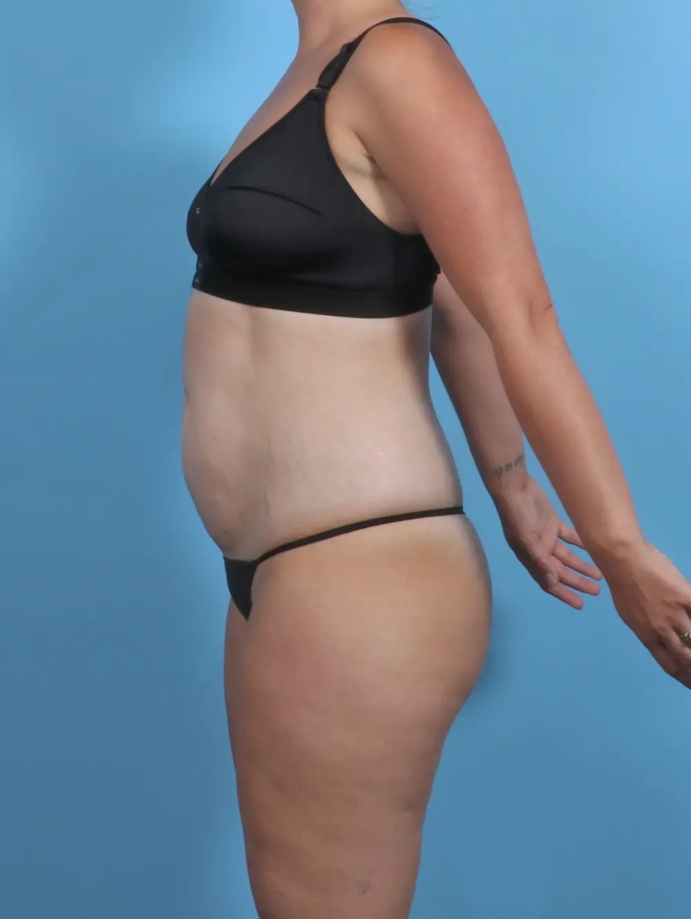 Tummy Tuck Patient Photo - Case 47233 - before view-2