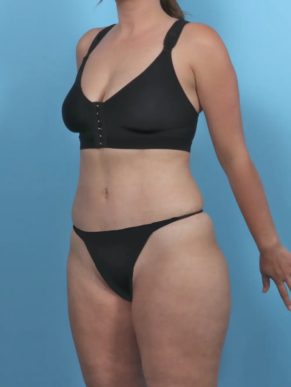 Tummy Tuck Patient Photo - Case 47233 - after view-1