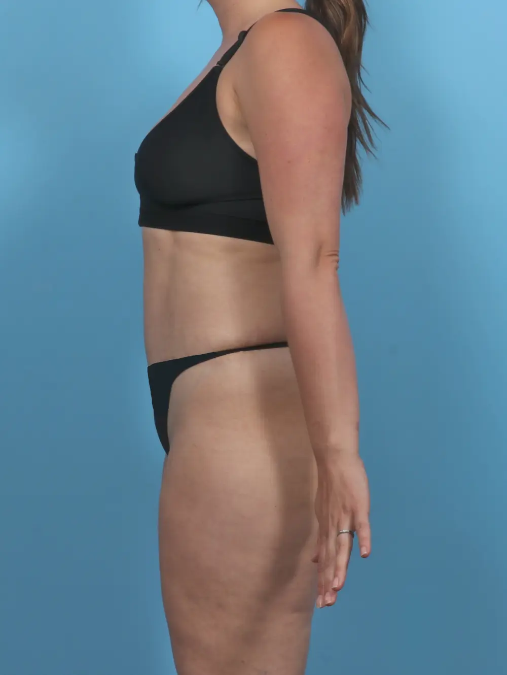 Tummy Tuck Patient Photo - Case 47233 - after view-2