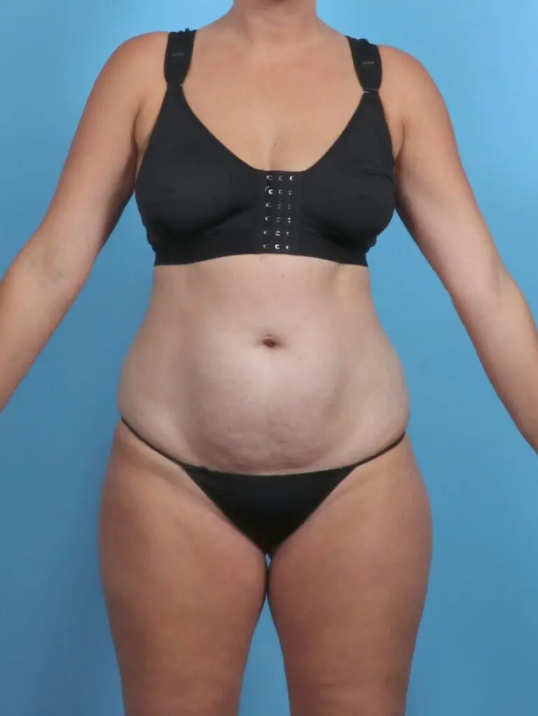 Tummy Tuck - Case 47233 - Before