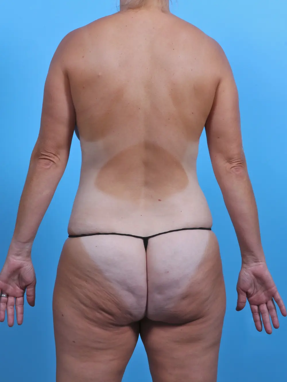 Breast Lift/Reduction with Implants Patient Photo - Case 47243 - before view-3