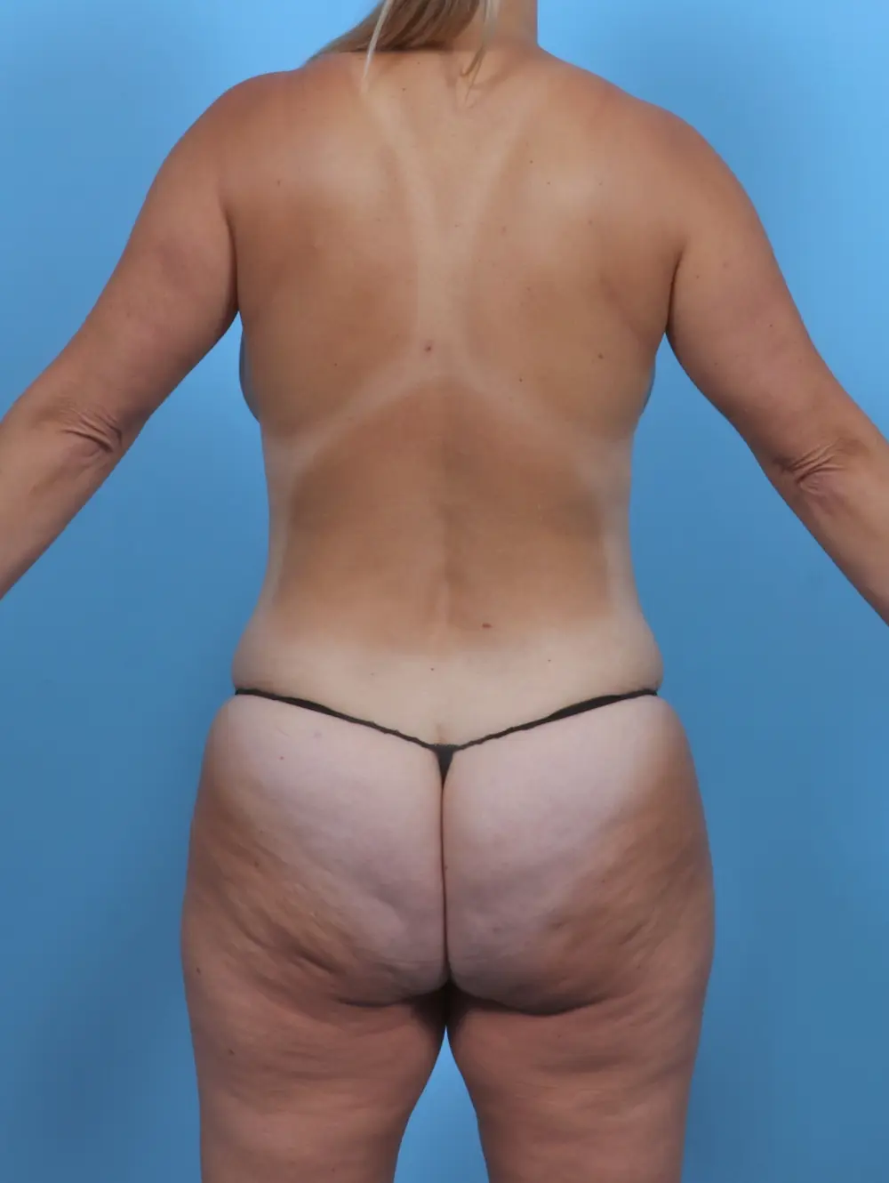 Breast Lift/Reduction with Implants Patient Photo - Case 47243 - after view-3