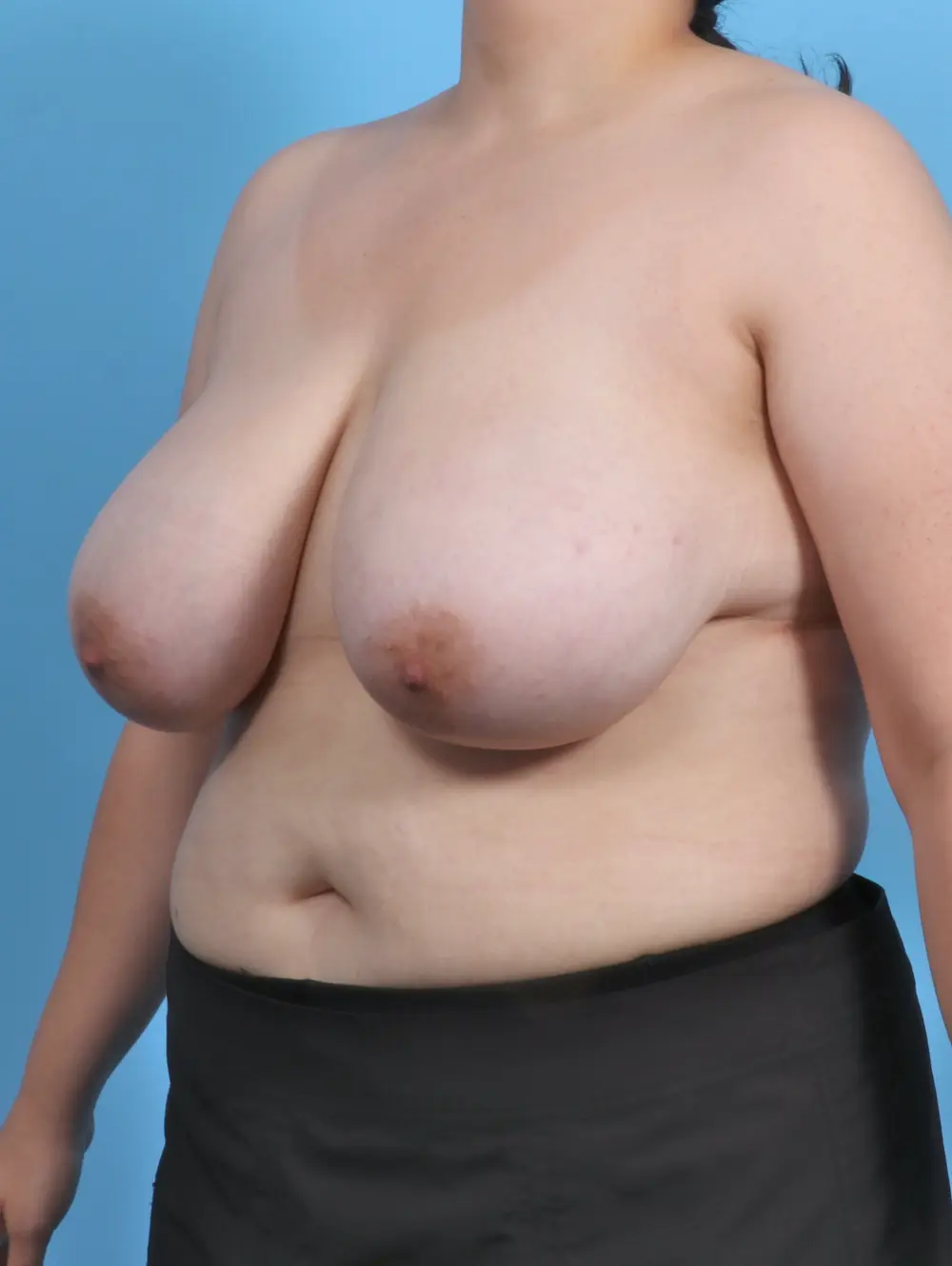Breast Lift/Reduction w/o Implants Patient Photo - Case 47286 - before view-1