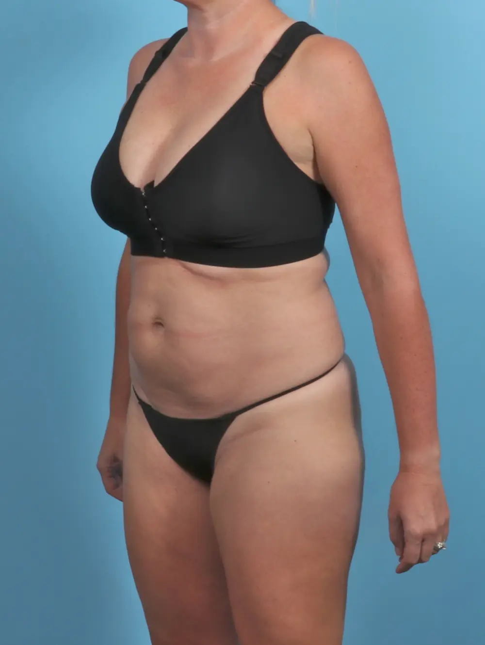 Tummy Tuck Patient Photo - Case 47302 - before view-1