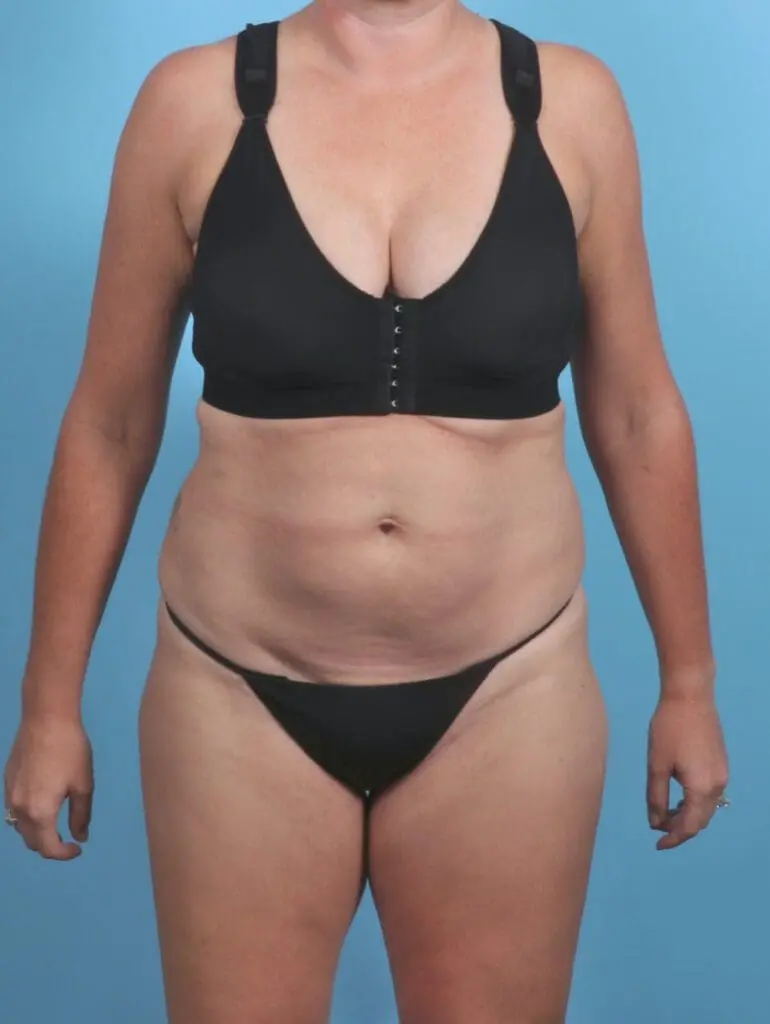 Tummy Tuck - Case 47302 - Before