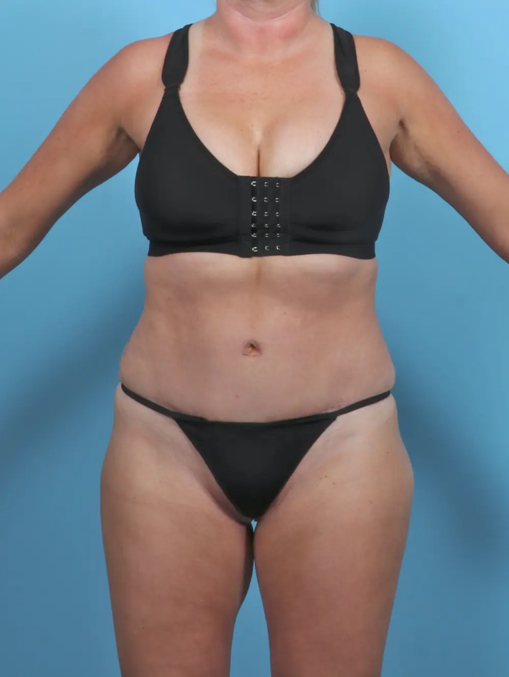 Tummy Tuck Patient Photo - Case 47302 - after view