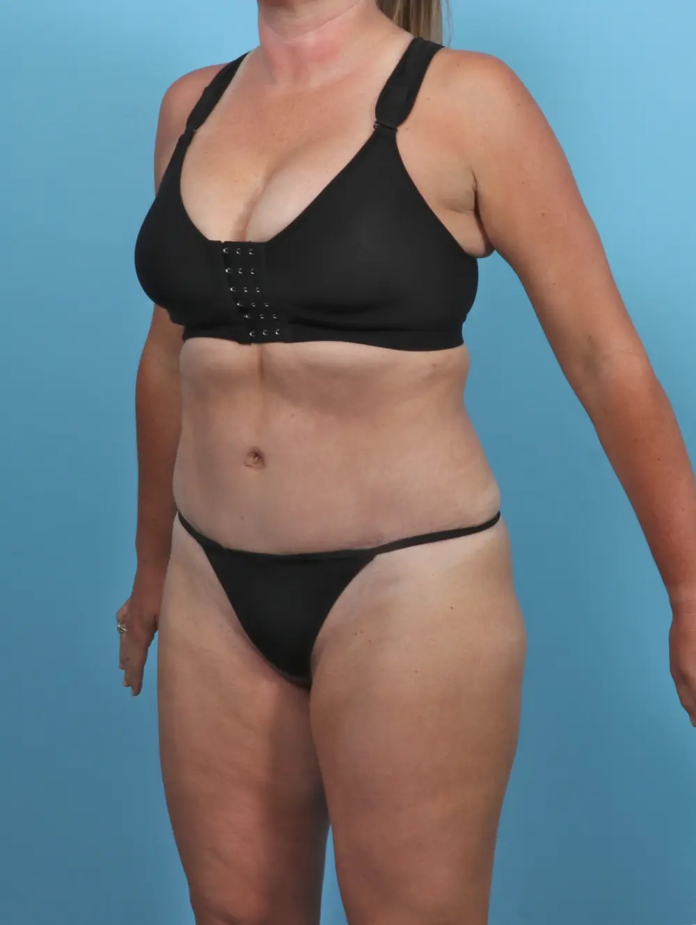 Tummy Tuck Patient Photo - Case 47302 - after view-1