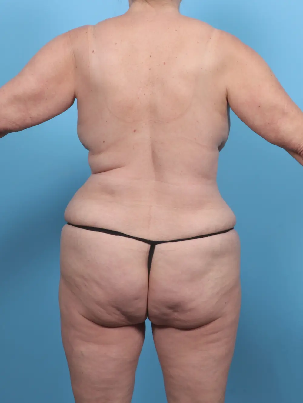 Breast Lift/Reduction w/o Implants Patient Photo - Case 47312 - before view-3