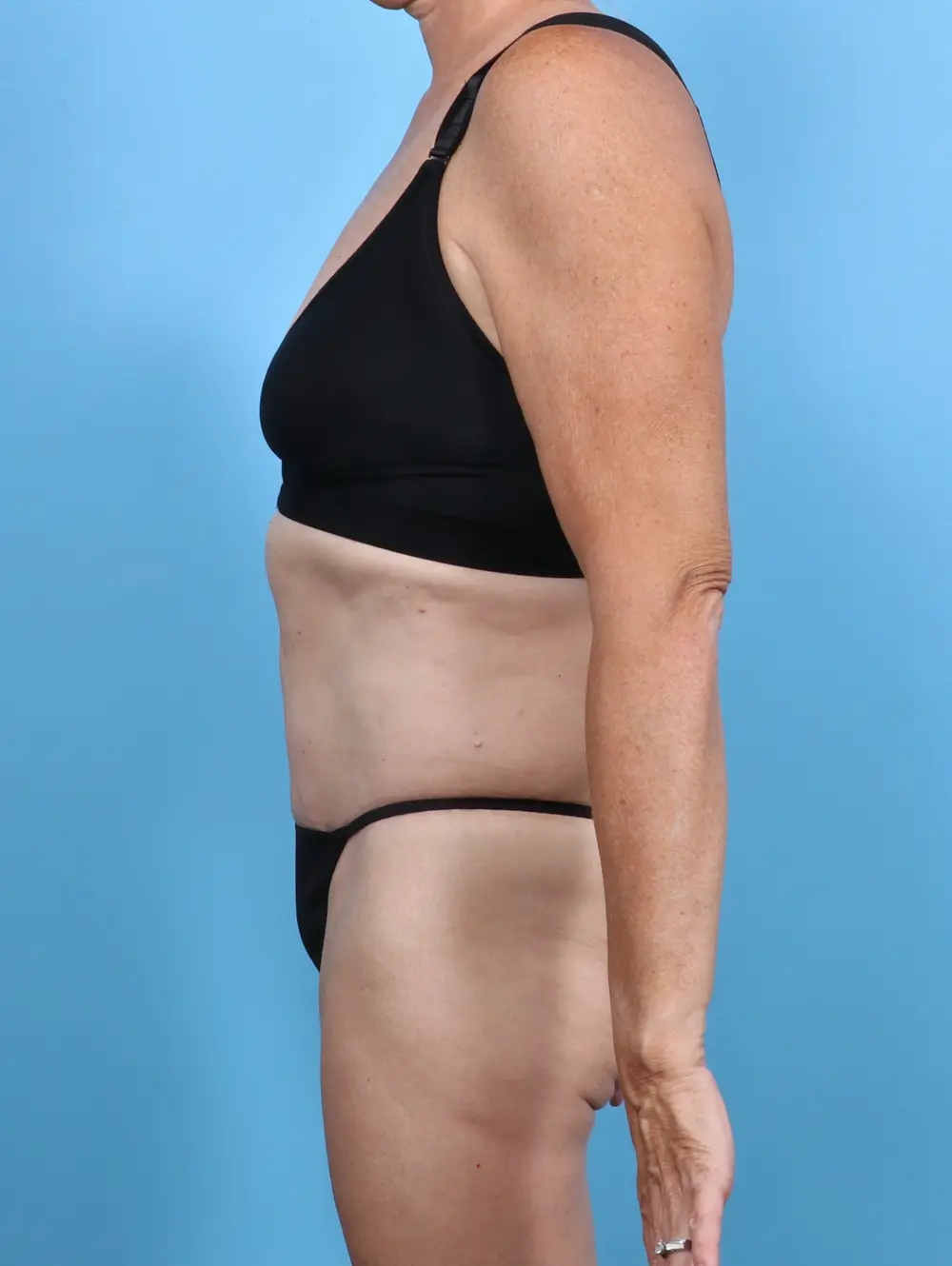 Tummy Tuck Patient Photo - Case 47322 - after view-2