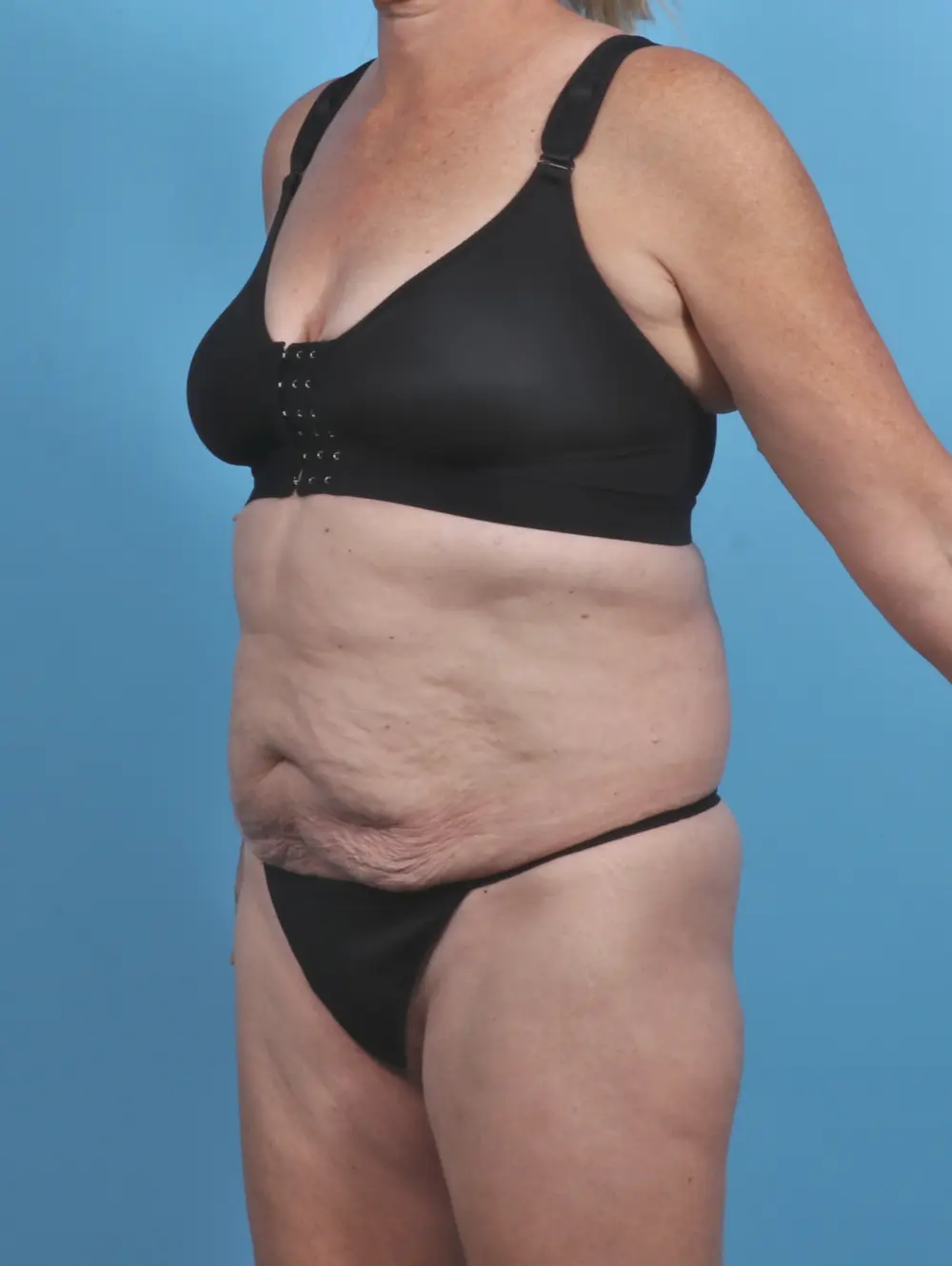 Tummy Tuck Patient Photo - Case 47322 - before view-1