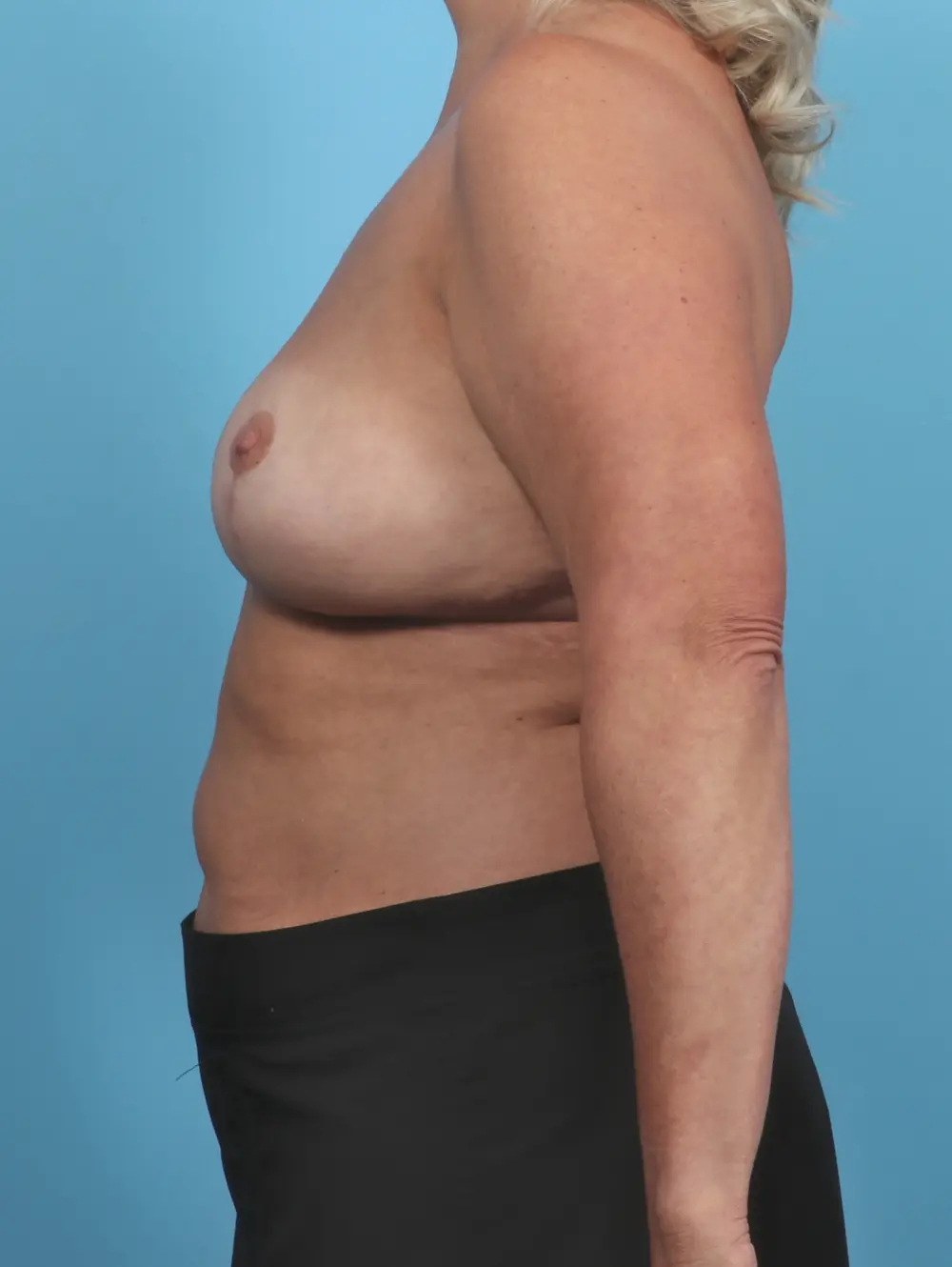 Breast Implant Removal Patient Photo - Case 47354 - after view-2