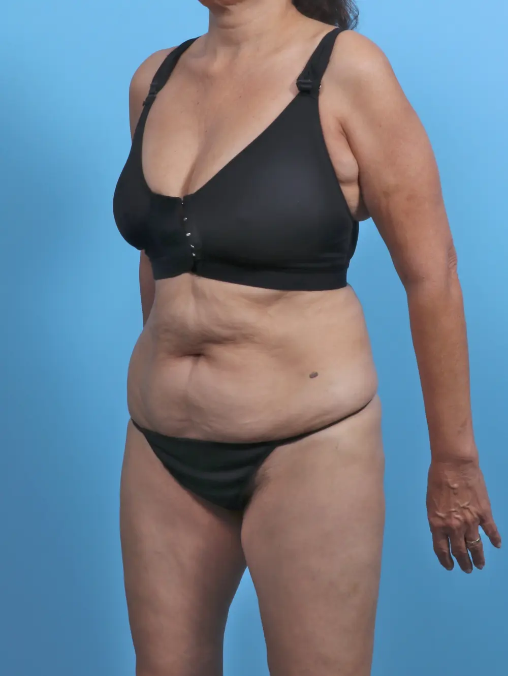 Tummy Tuck Patient Photo - Case 47362 - before view-1