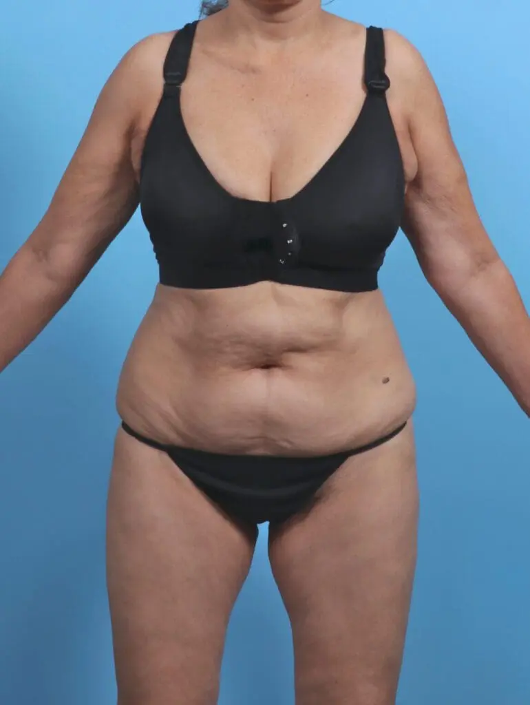 Tummy Tuck - Case 47362 - Before