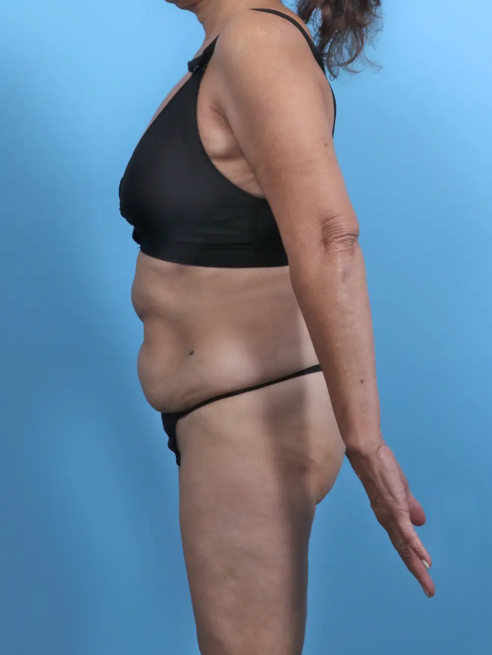 Tummy Tuck Patient Photo - Case 47362 - before view-2