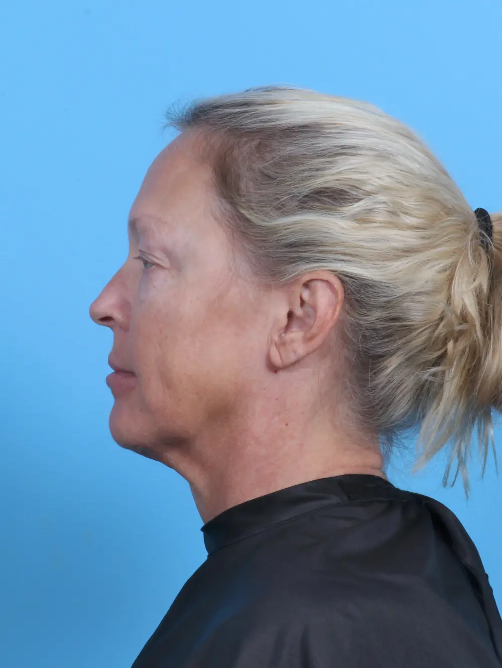 Eyelid Surgery Patient Photo - Case 47386 - before view-2