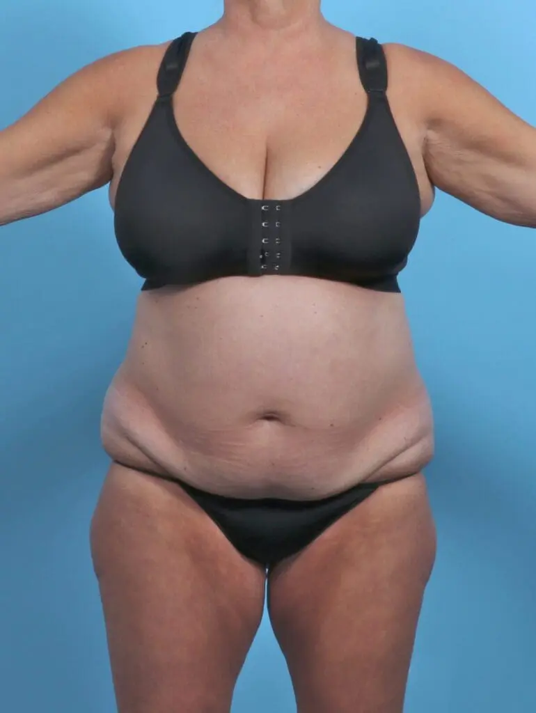 Tummy Tuck - Case 47370 - Before