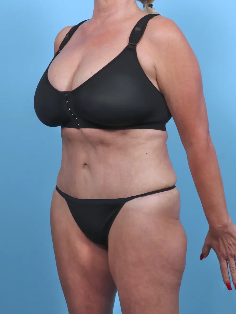 Tummy Tuck Patient Photo - Case 47370 - after view-1