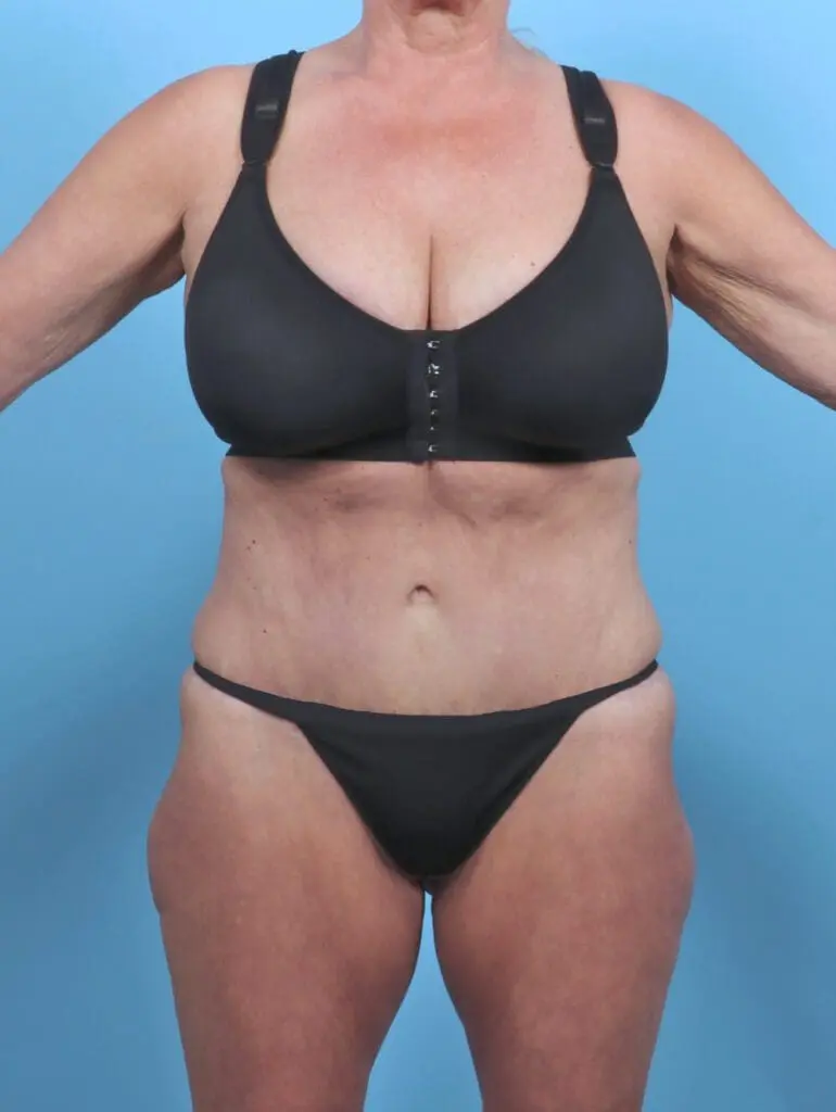 Tummy Tuck - Case 47370 - After