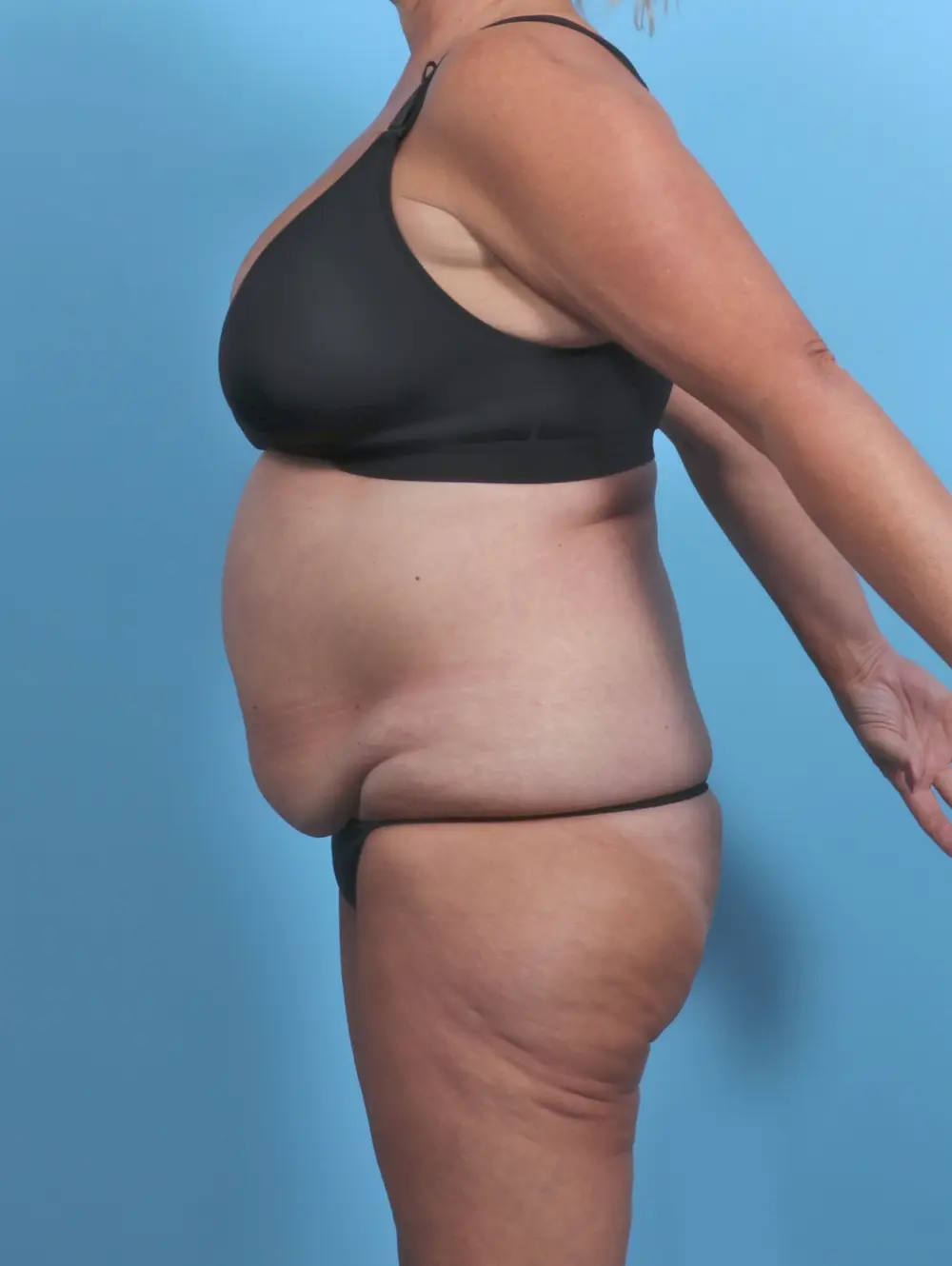 Tummy Tuck Patient Photo - Case 47370 - before view-2