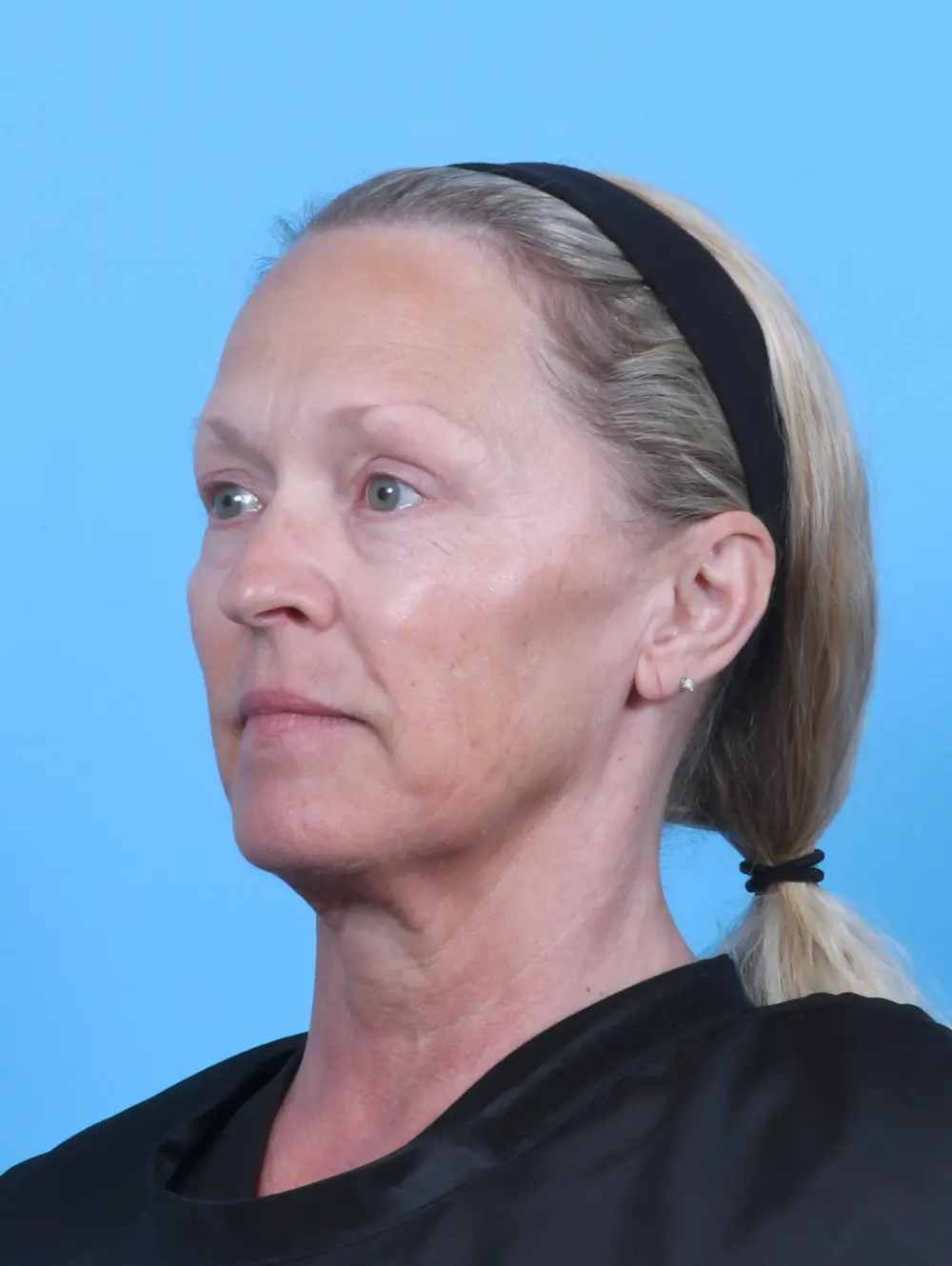 Eyelid Surgery Patient Photo - Case 47386 - after view-1