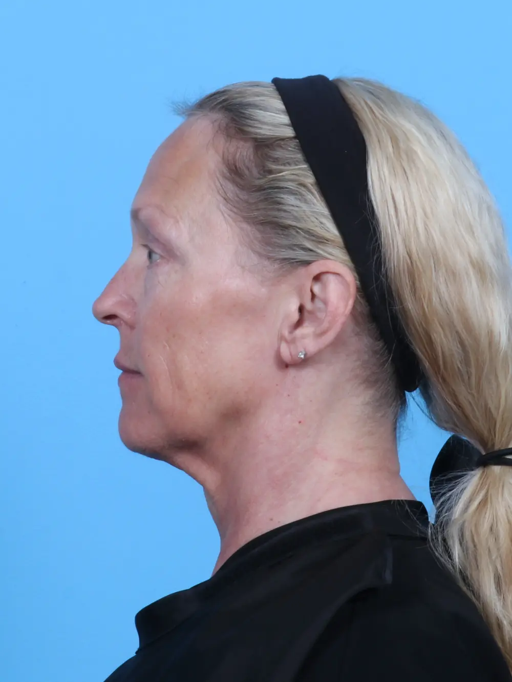 Eyelid Surgery Patient Photo - Case 47386 - after view-2