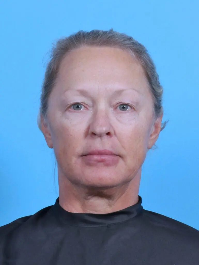 Eyelid Surgery - Case 47386 - Before