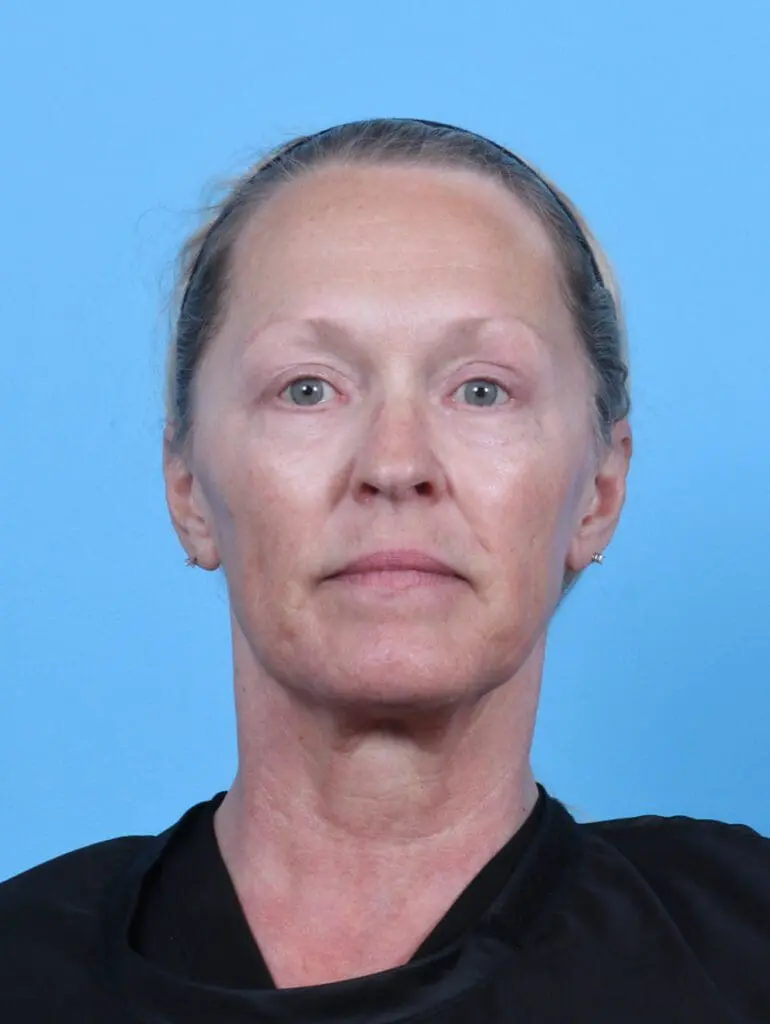 Eyelid Surgery - Case 47386 - After