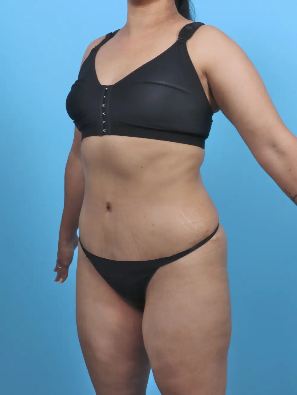 Tummy Tuck Patient Photo - Case 47388 - after view-1