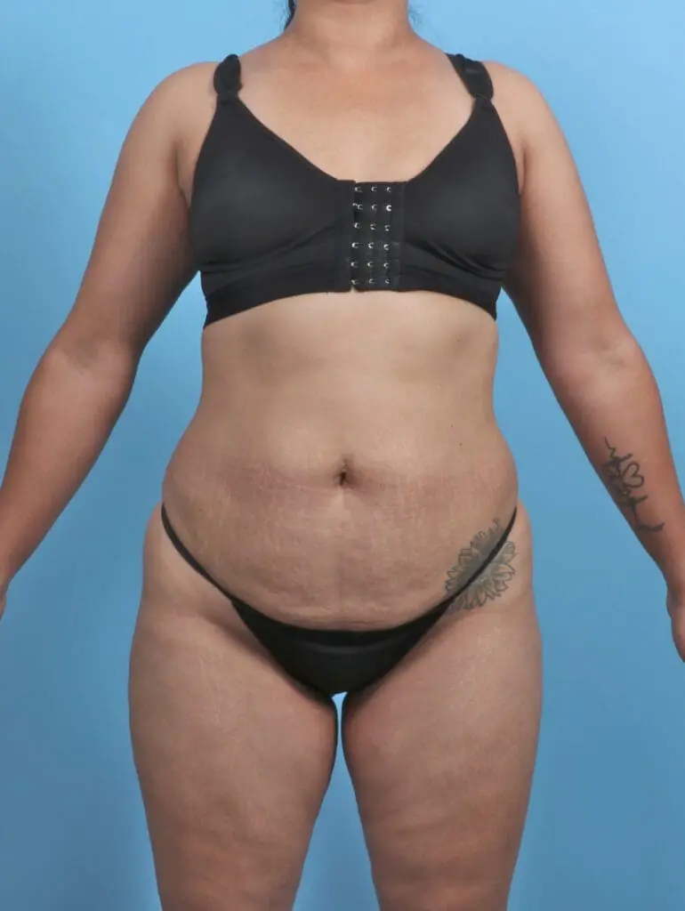 Tummy Tuck - Case 47388 - Before