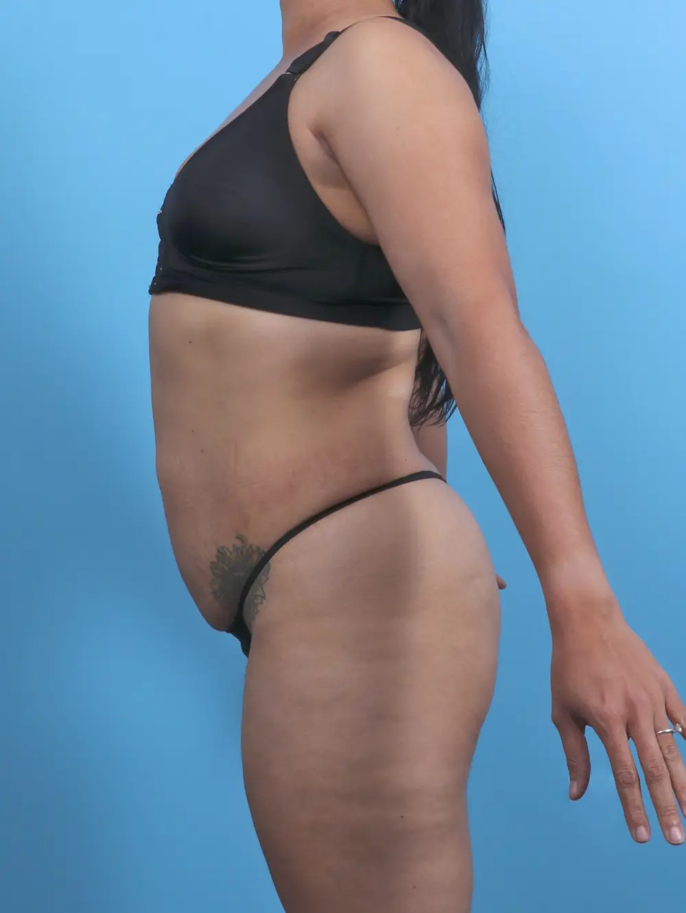 Tummy Tuck Patient Photo - Case 47388 - before view-2