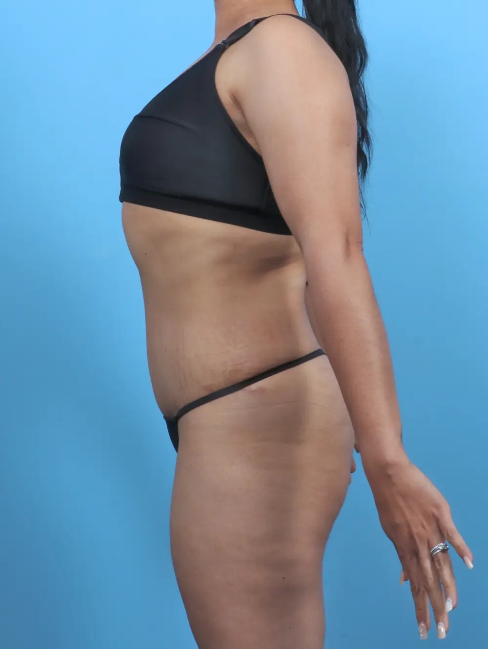 Tummy Tuck Patient Photo - Case 47388 - after view-2