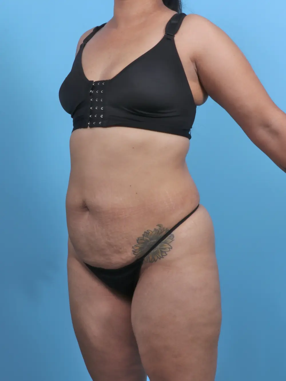 Tummy Tuck Patient Photo - Case 47388 - before view-1
