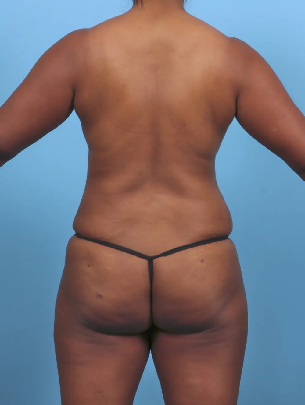 Tummy Tuck Patient Photo - Case 47412 - after view-3