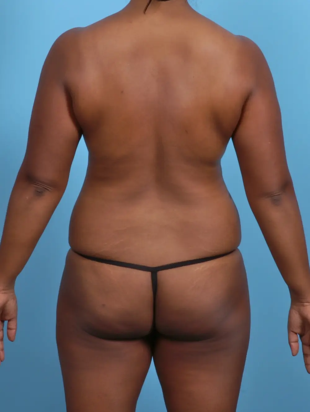Tummy Tuck Patient Photo - Case 47412 - before view-3