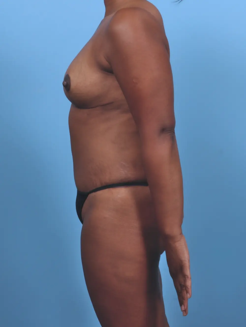 Tummy Tuck Patient Photo - Case 47412 - after view-2