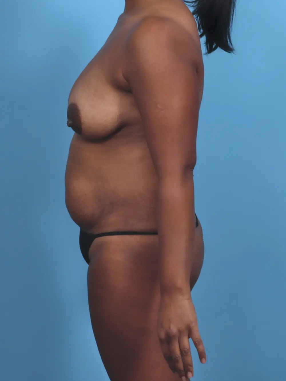Tummy Tuck Patient Photo - Case 47412 - before view-2