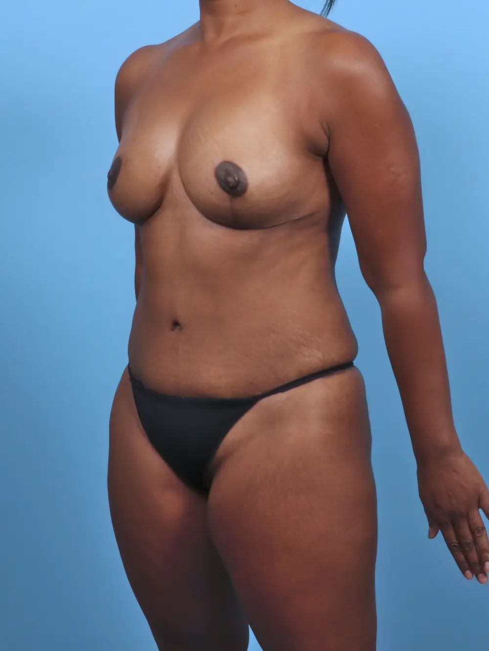 Tummy Tuck Patient Photo - Case 47412 - after view-1
