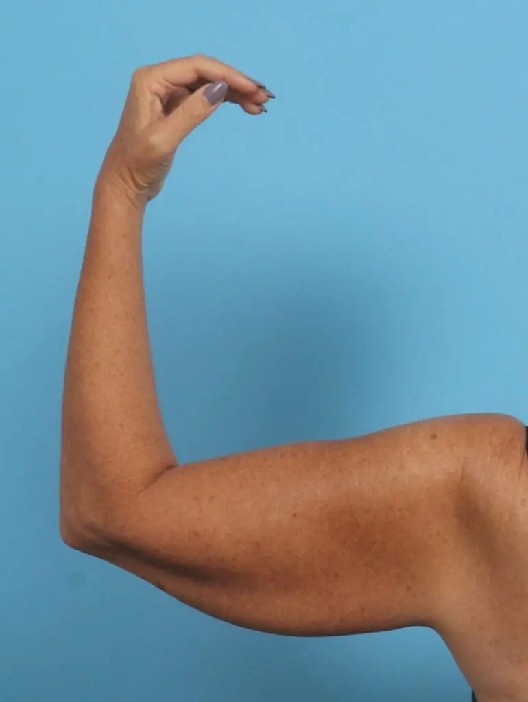 Arm Lift - Case 47422 - Before