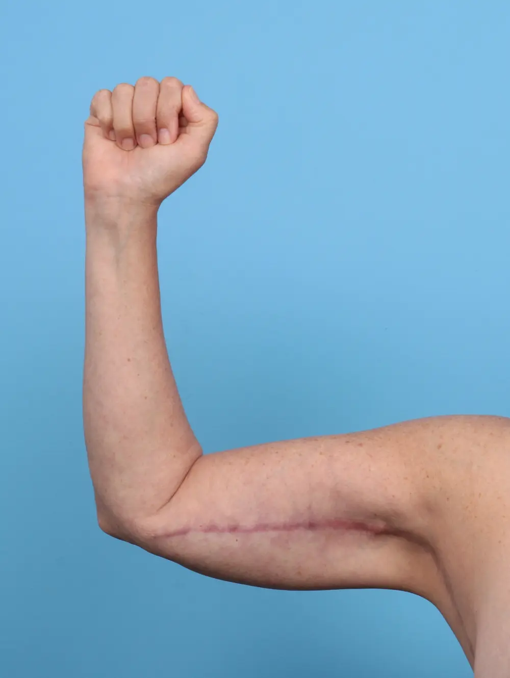 Arm Lift Patient Photo - Case 47422 - after view-1