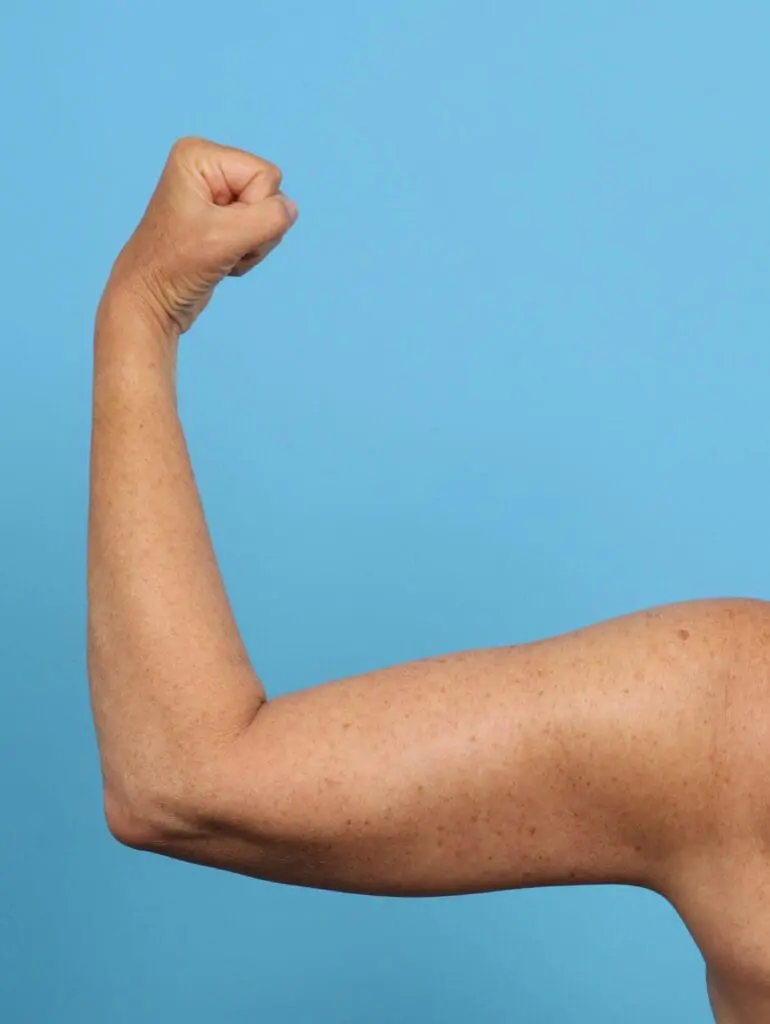 Arm Lift - Case 47422 - After