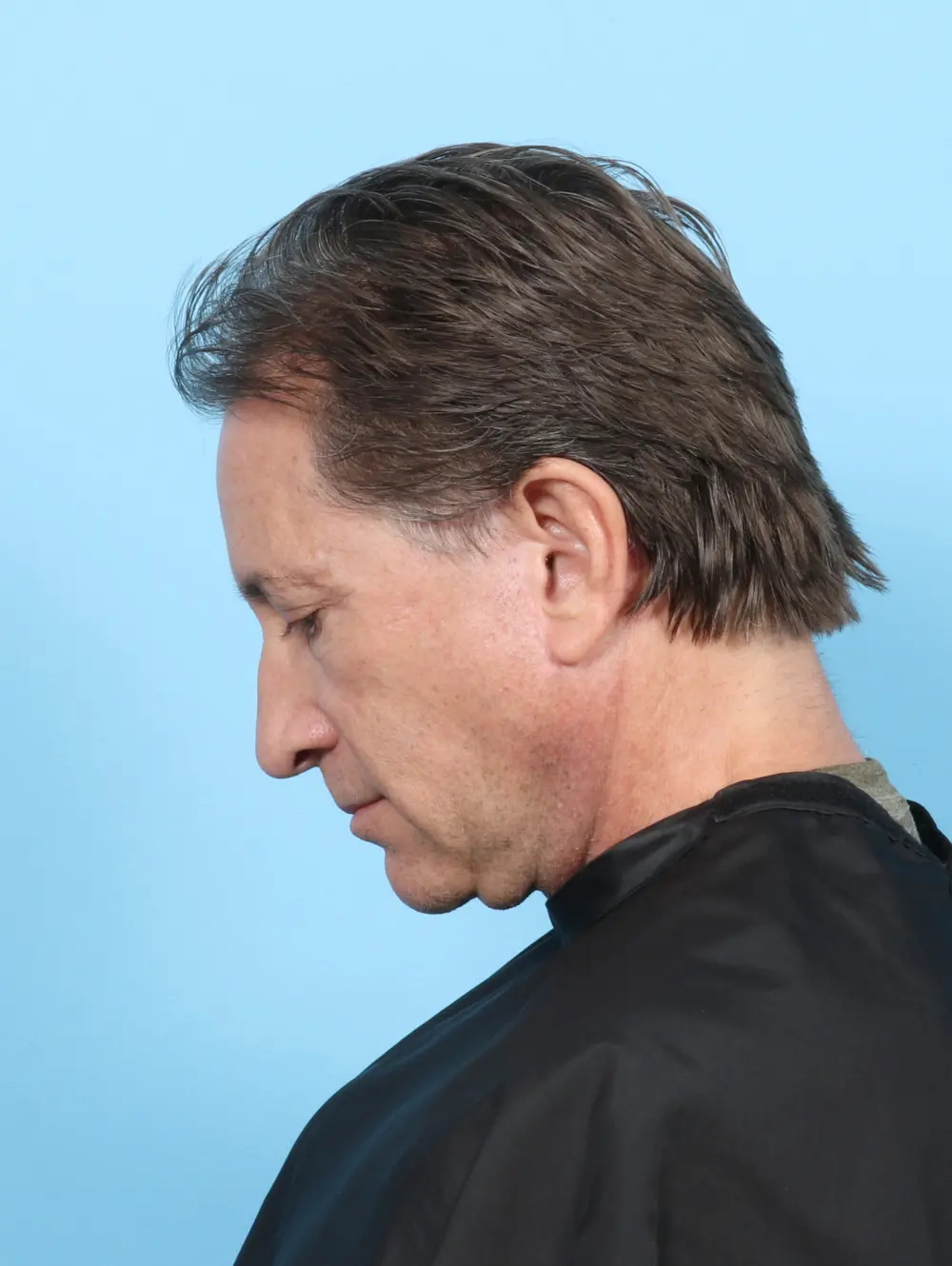 Facelift / Neck Lift Patient Photo - Case 47562 - after view-3