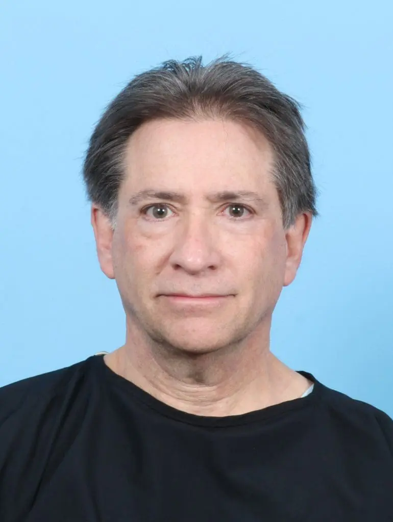 Facelift / Neck Lift - Case 47562 - Before