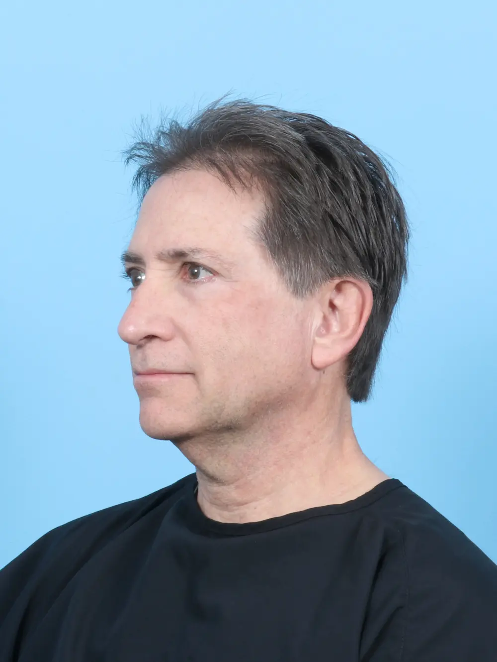 Facelift / Neck Lift Patient Photo - Case 47562 - before view-1