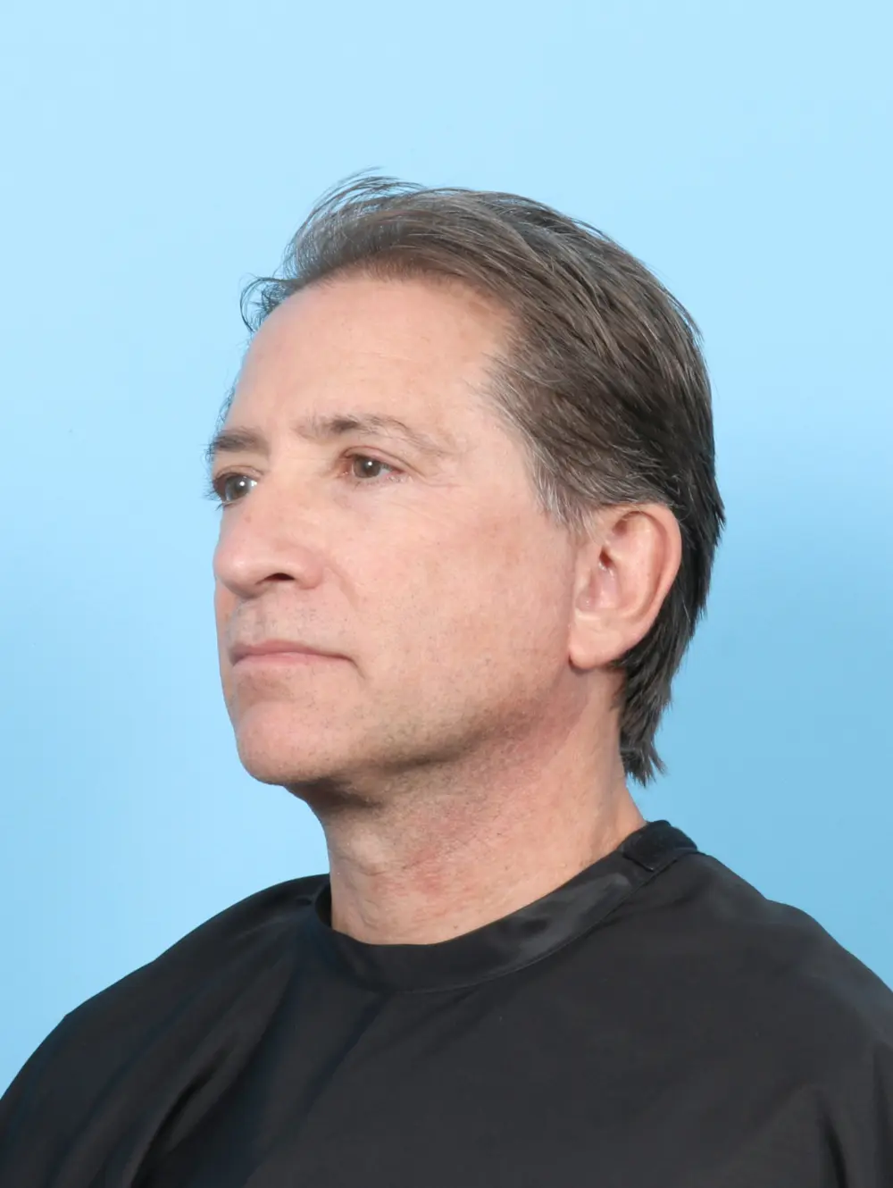 Facelift / Neck Lift Patient Photo - Case 47562 - after view-1