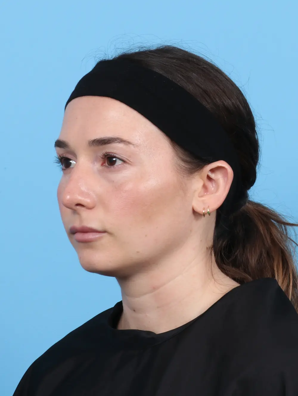 Rhinoplasty Patient Photo - Case 47578 - after view-1