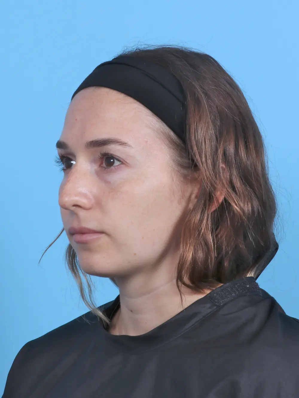 Rhinoplasty Patient Photo - Case 47578 - before view-1